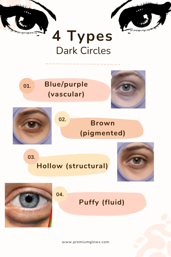 Comparison chart of vascular, pigmented, structural and puffy dark circles